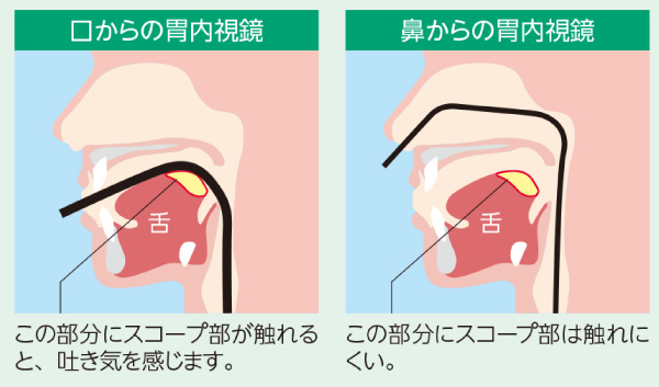 経口内視鏡検査と胃内視鏡検査